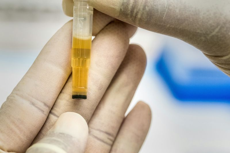 Comprendre la couleur de l’urine : guide complet et accessible