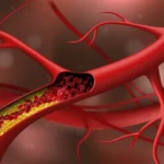 Réduisez votre taux de cholestérol en évitant ces 10 aliments : Guide pour une santé cardiaque au Nigéria